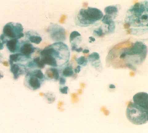 Moins d’urine : infection, traumatisme, néphropathie